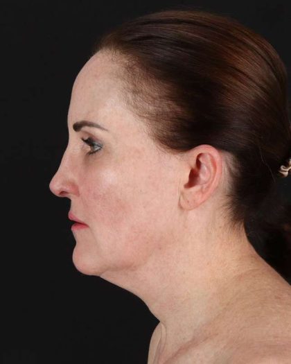 All Me Facelift Before & After Patient #472