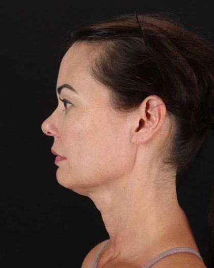 All Me Facelift Before & After Patient #483