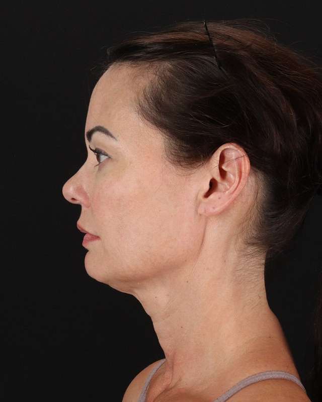All Me Facelift Before & After Patient #483