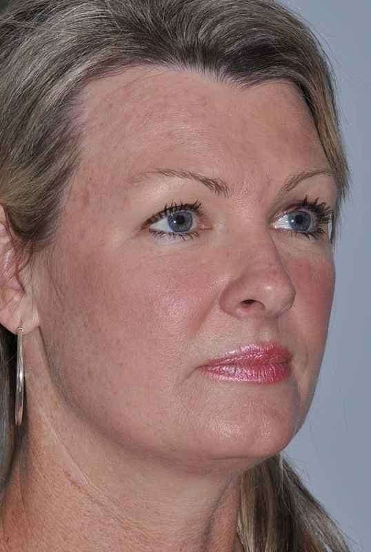 All Me Facelift Before & After Patient #781