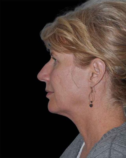 All Me Facelift Before & After Patient #263