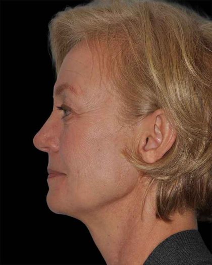 All Me Facelift Before & After Patient #274