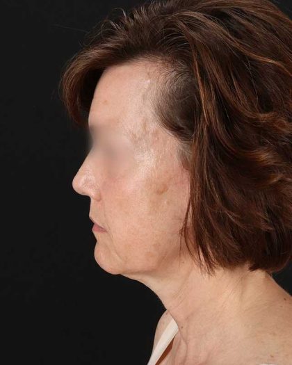 All Me Facelift Before & After Patient #229