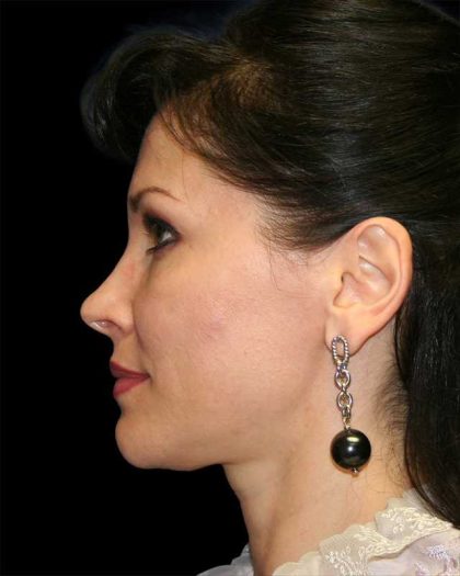 All Me Facelift Before & After Patient #286