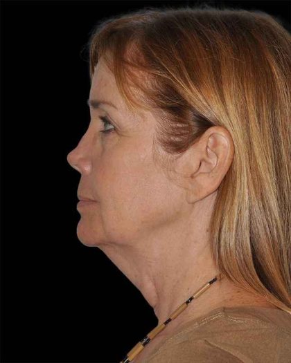 All Me Facelift Before & After Patient #297