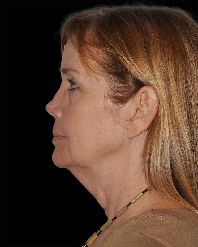 All Me Facelift Before & After Patient #297