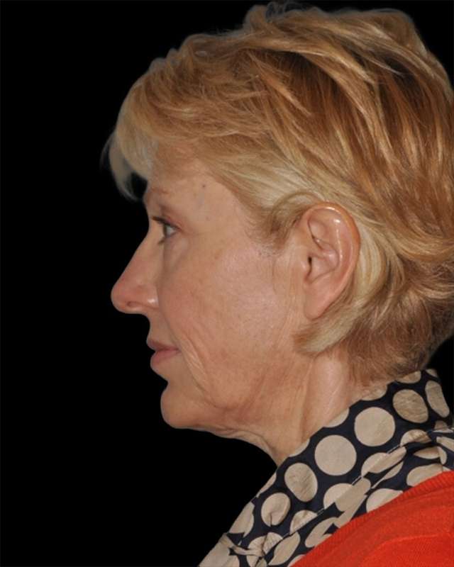 All Me Facelift Before & After Patient #308