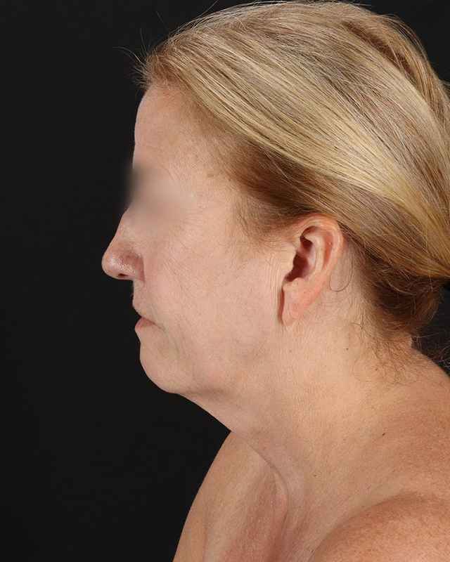 All Me Facelift Before & After Patient #320