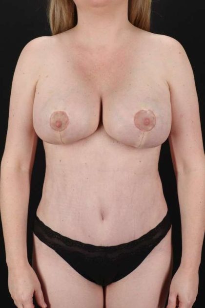 All Me Augmentation Before & After Patient #1748