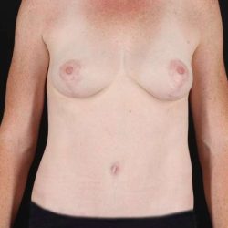 All Me Augmentation Before & After Patient #1762
