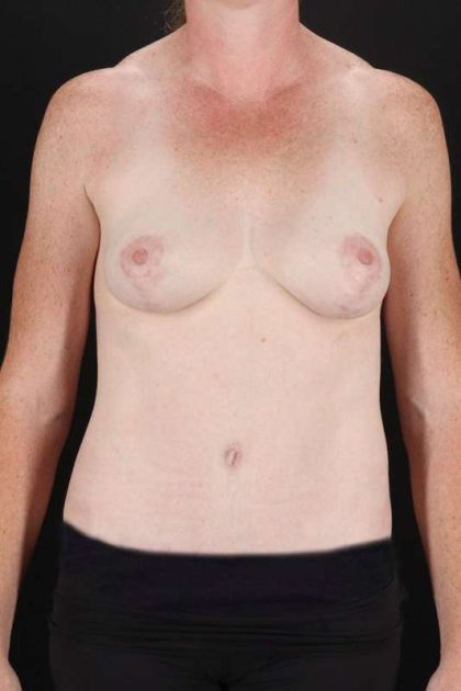 All Me Augmentation Before & After Patient #1762