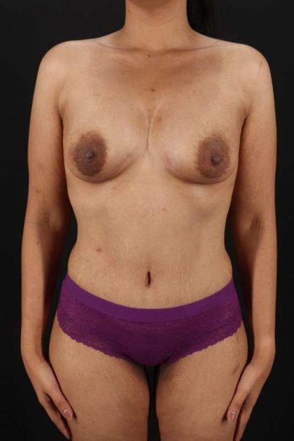 All Me Augmentation Before & After Patient #1769