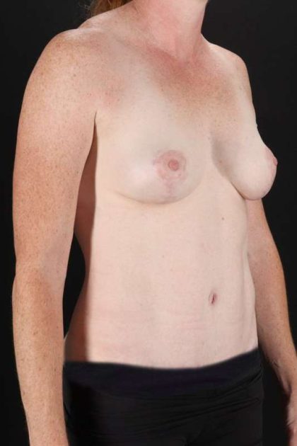 All Me Augmentation Before & After Patient #1762