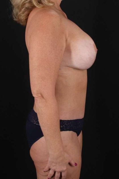 All Me Augmentation Before & After Patient #1755
