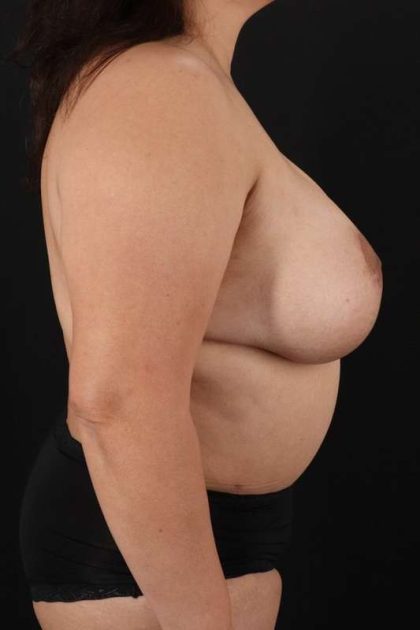 All Me Augmentation Before & After Patient #1776