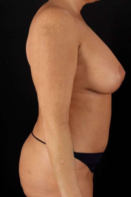 All Me Augmentation Before & After Patient #1797