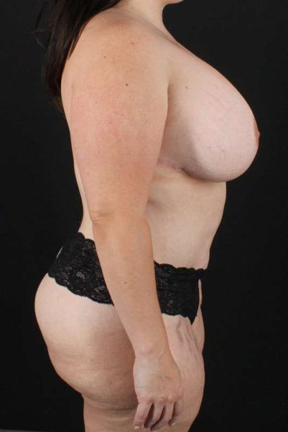 All Me Augmentation Before & After Patient #1804
