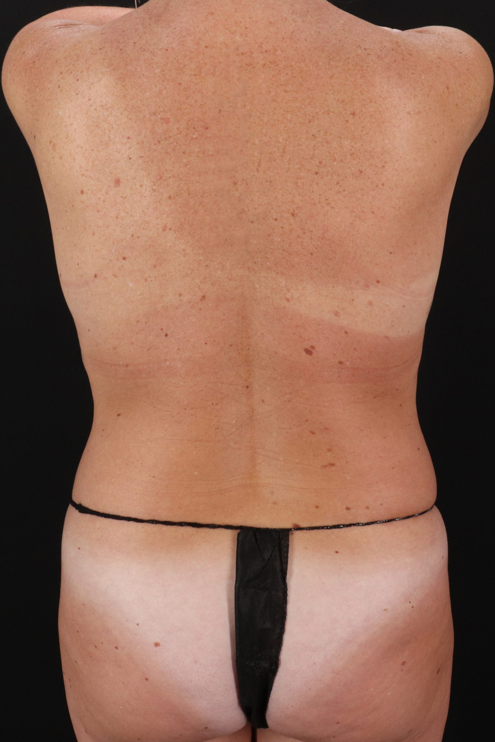 All Me Augmentation Before & After Patient #1894