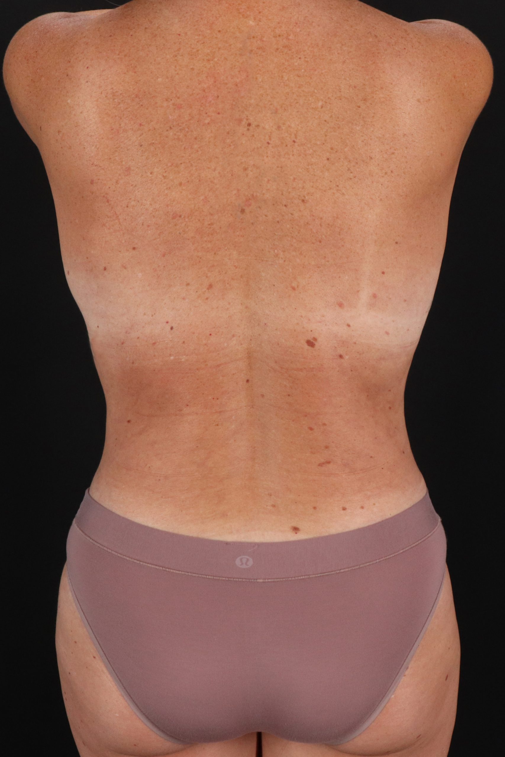 All Me Augmentation Before & After Patient #1894