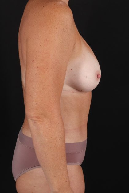 All Me Augmentation Before & After Patient #1894