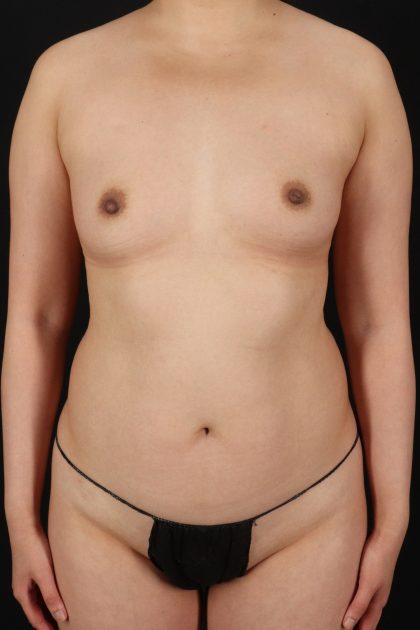 All Me Augmentation Before & After Patient #1903