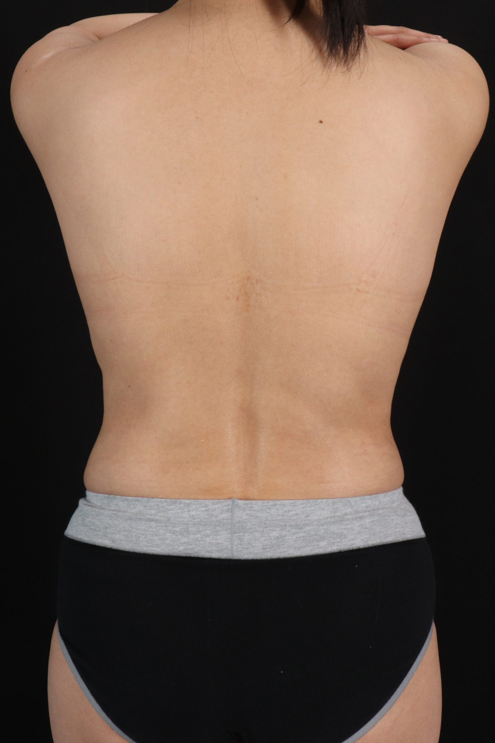All Me Augmentation Before & After Patient #1903