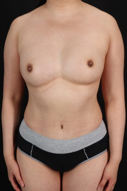 All Me Augmentation Before & After Patient #1903