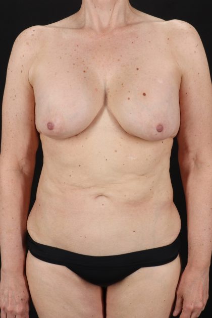 All Me Augmentation Before & After Patient #1904