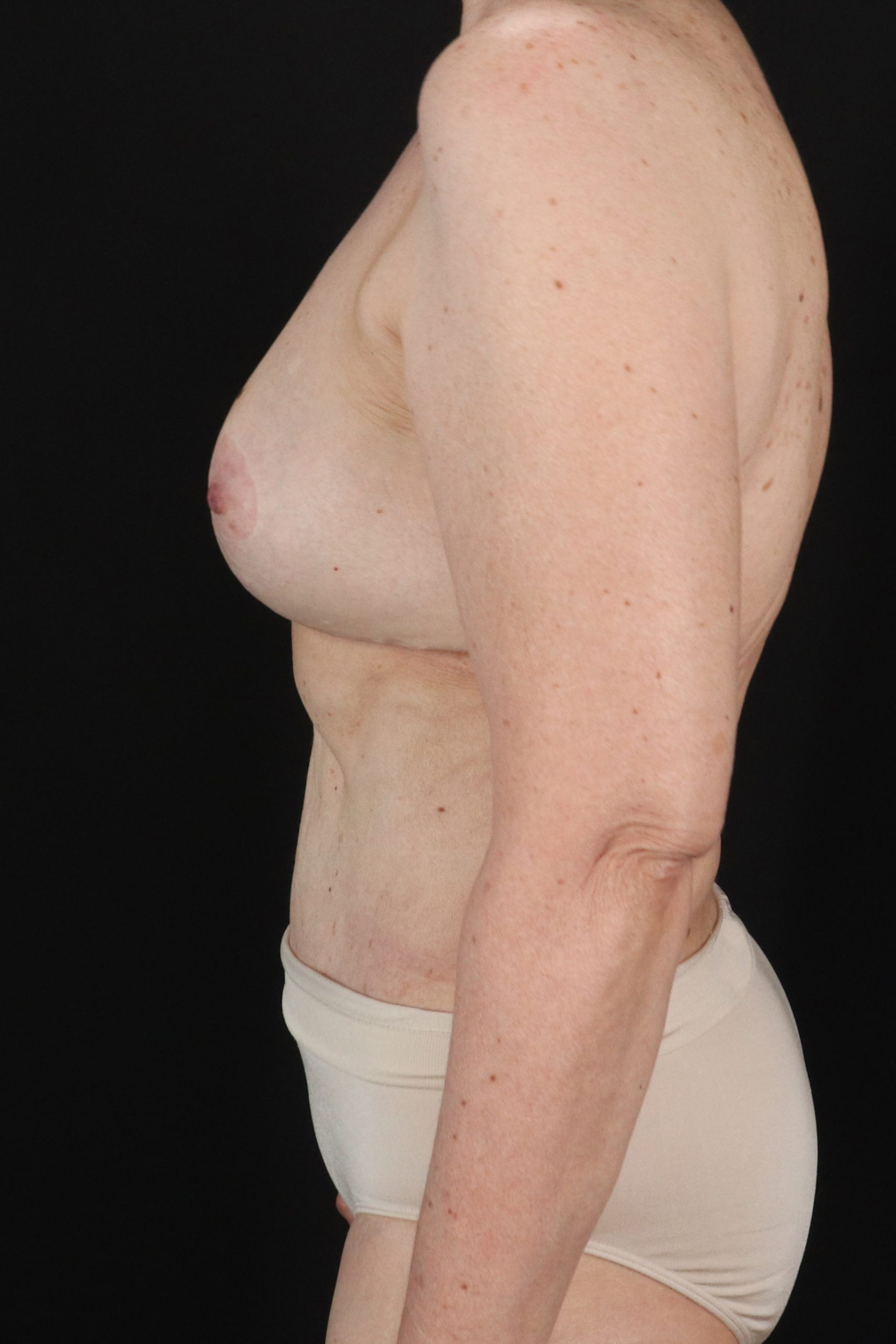 All Me Augmentation Before & After Patient #1904