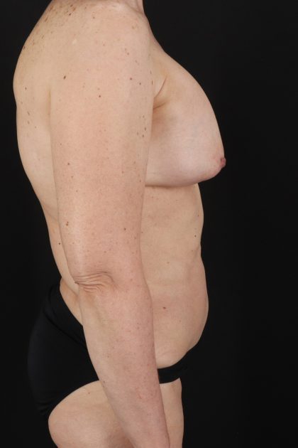 All Me Augmentation Before & After Patient #1904