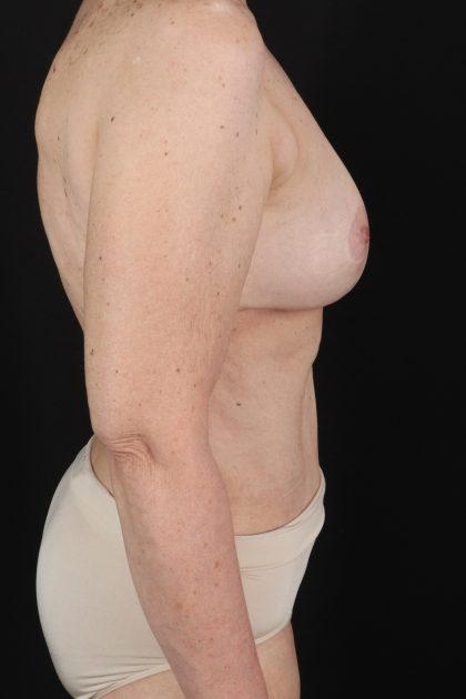 All Me Augmentation Before & After Patient #1904