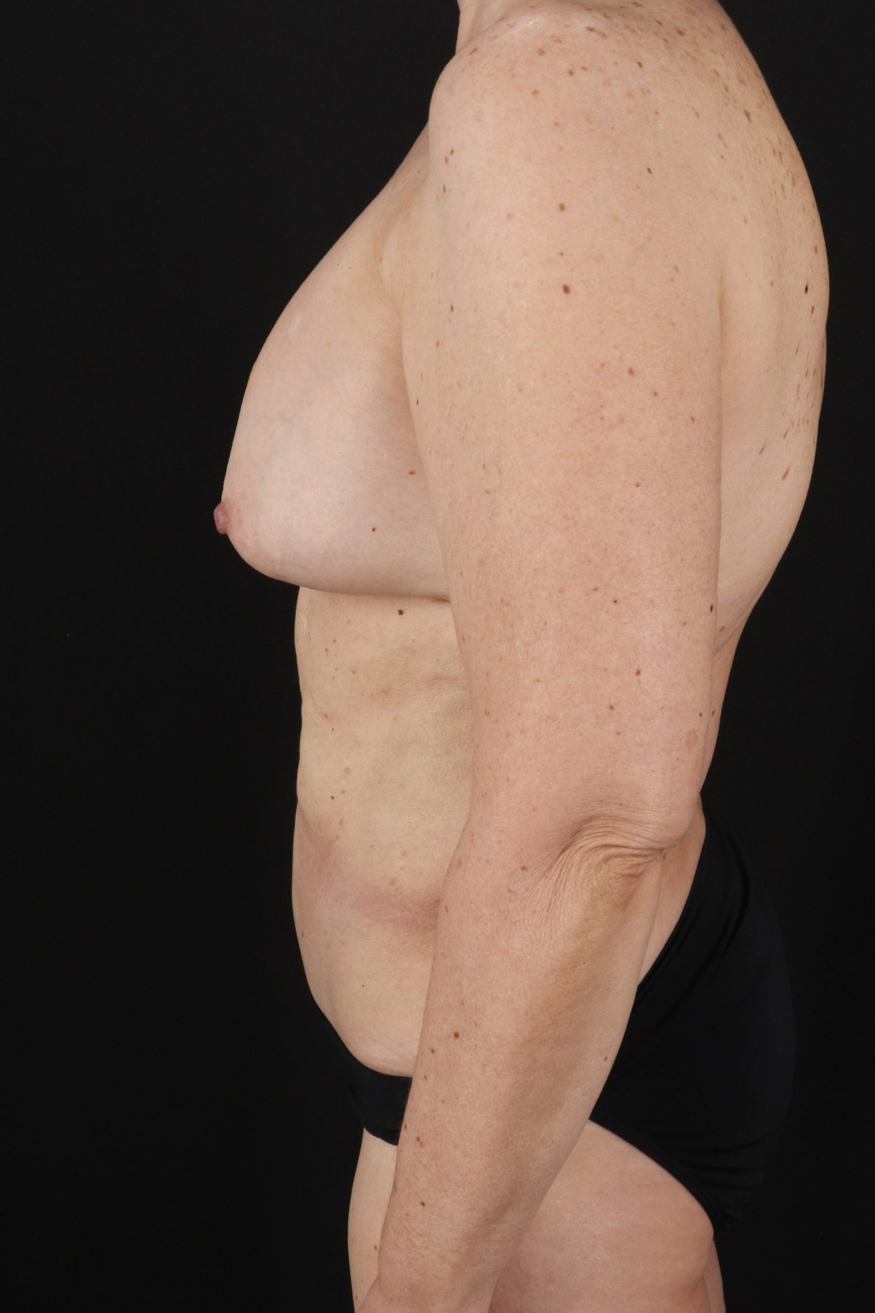 All Me Augmentation Before & After Patient #1904