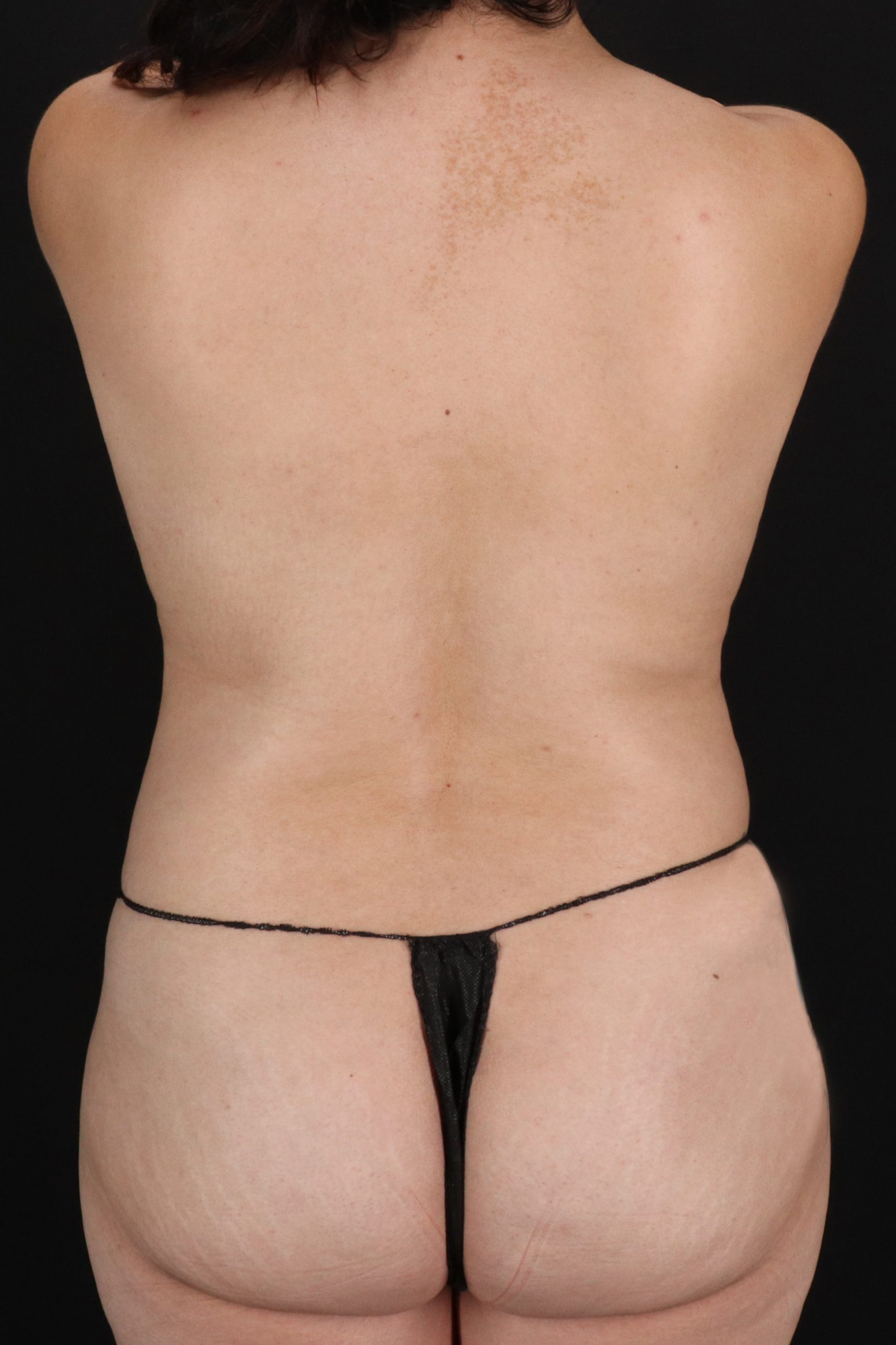 All Me Augmentation Before & After Patient #1905