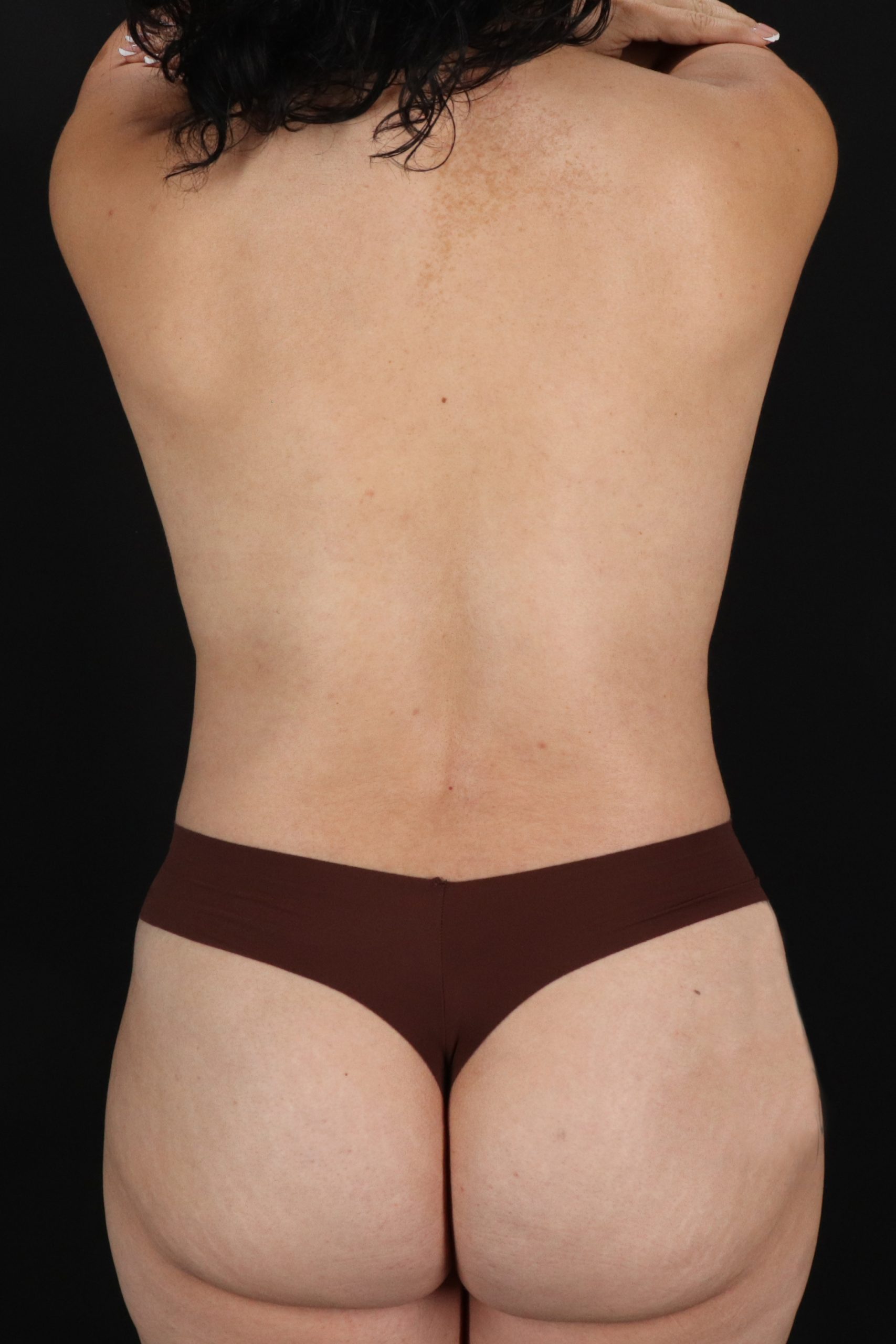 All Me Augmentation Before & After Patient #1905