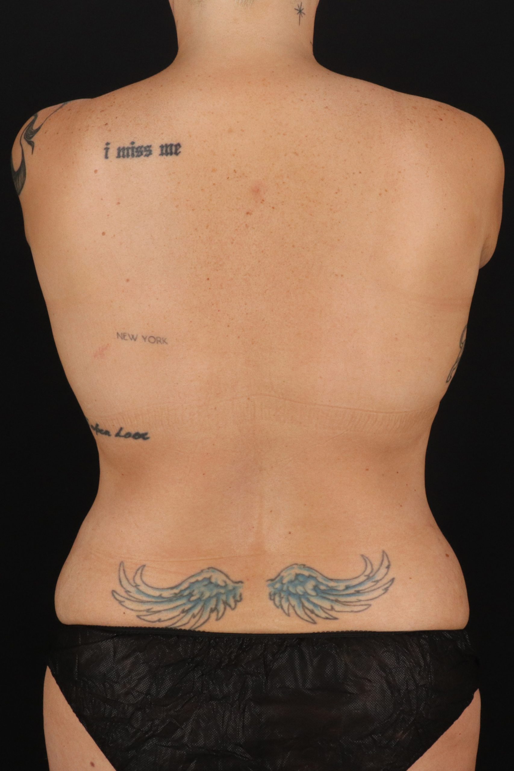 All Me Augmentation Before & After Patient #1906