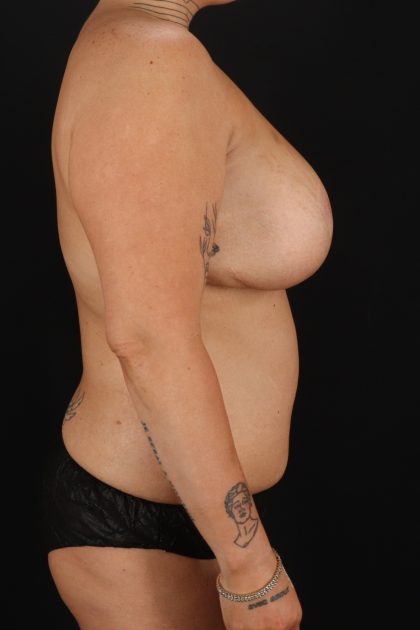 All Me Augmentation Before & After Patient #1906