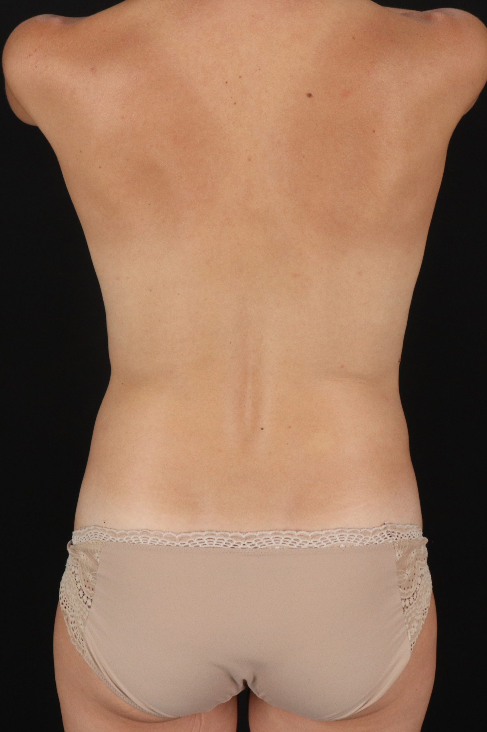 All Me Augmentation Before & After Patient #1907
