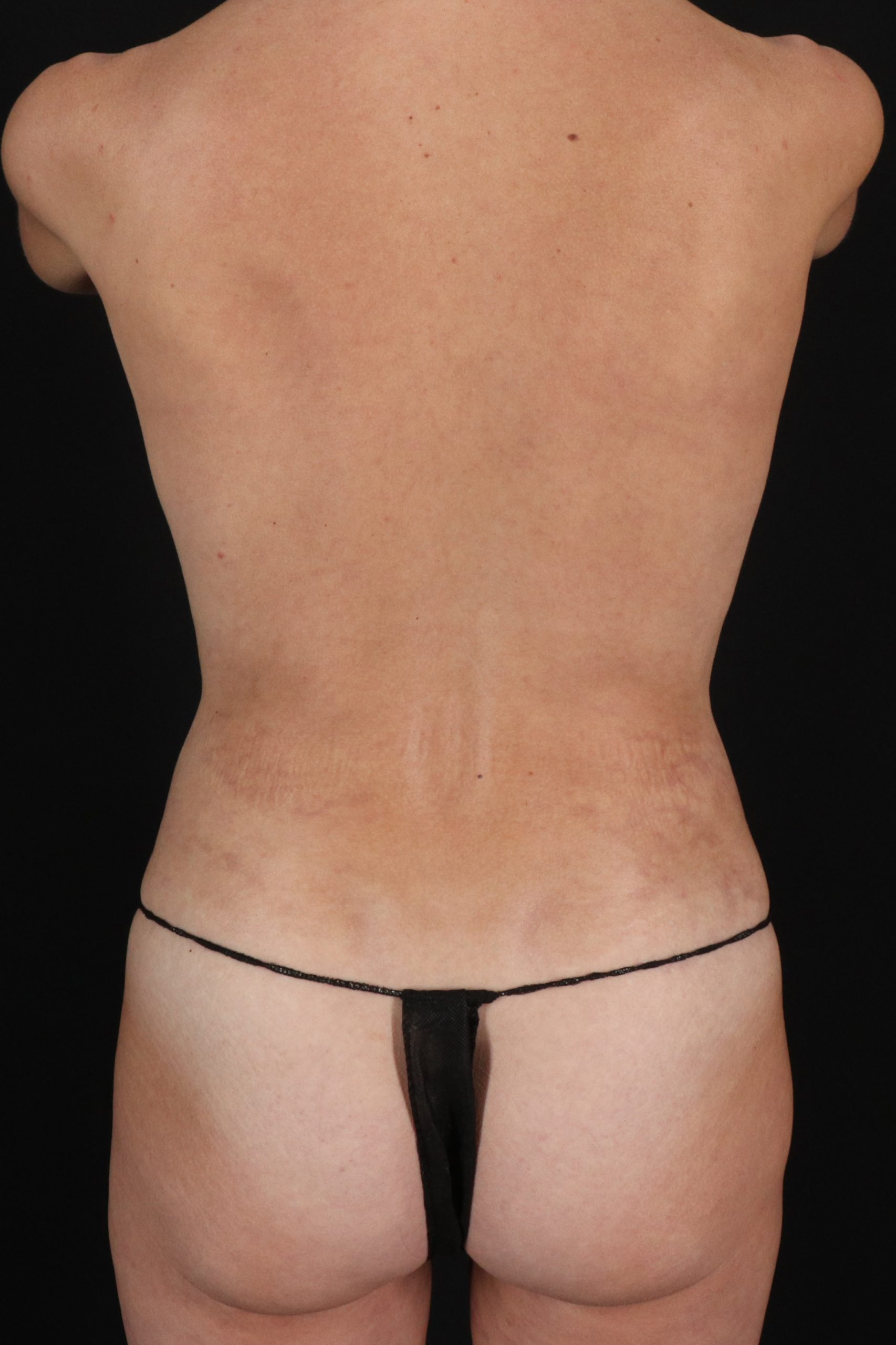 All Me Augmentation Before & After Patient #1907