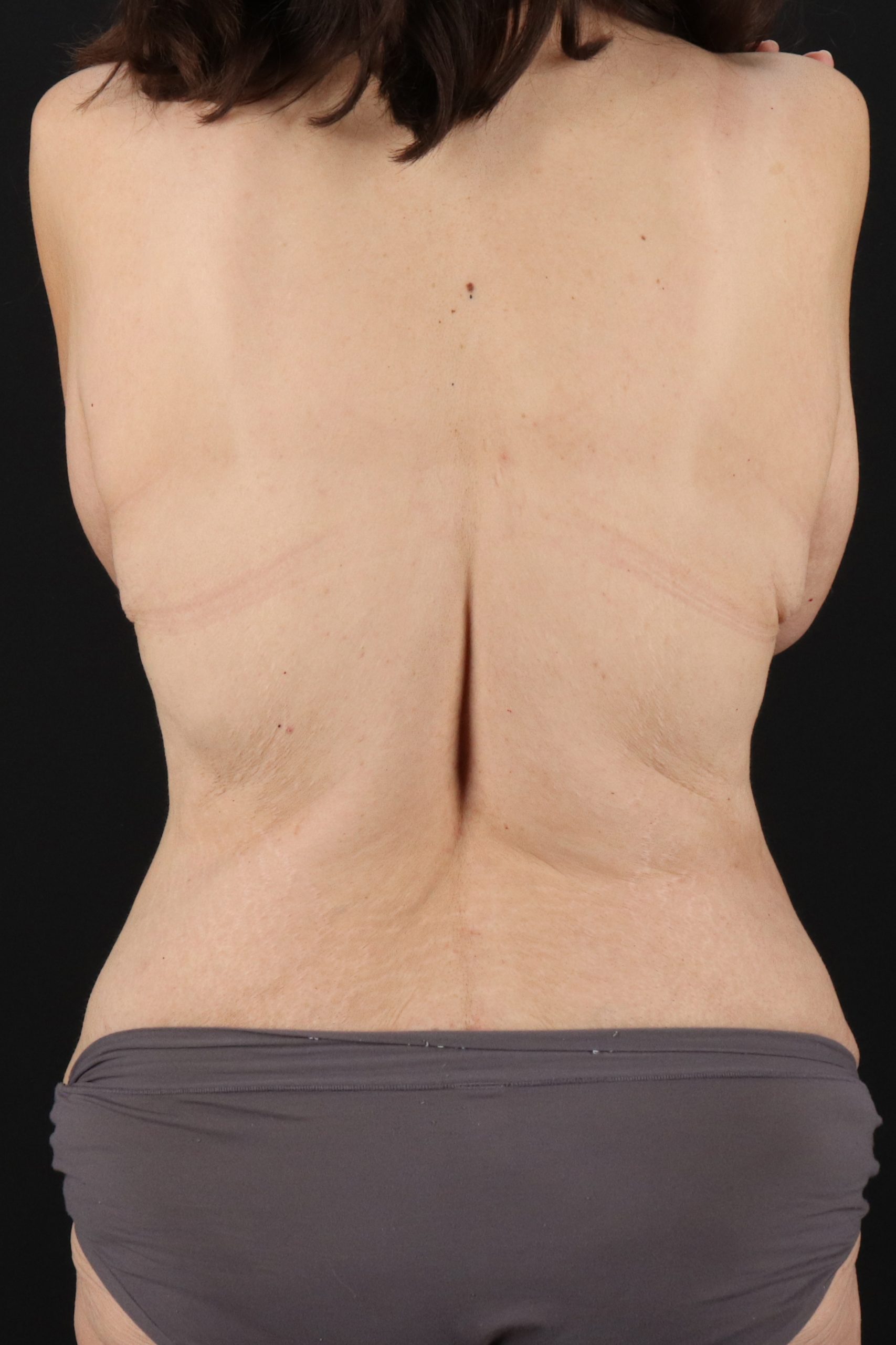 All Me Augmentation Before & After Patient #1908