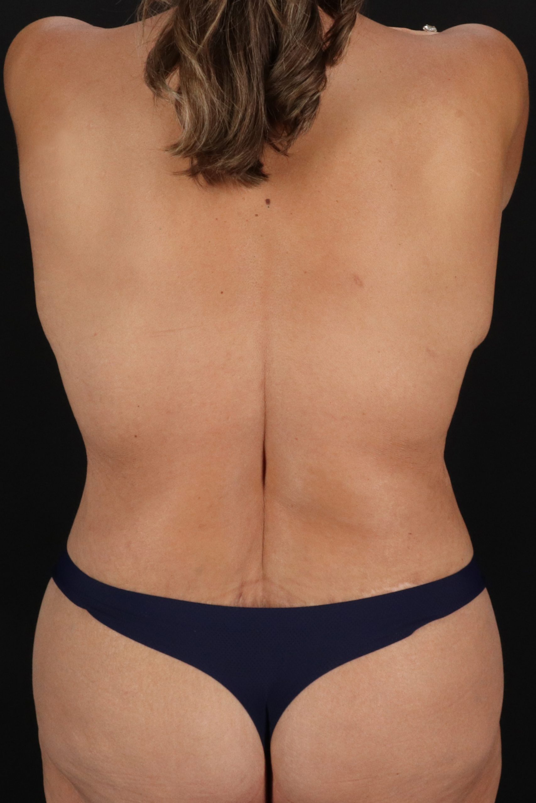 All Me Augmentation Before & After Patient #1908