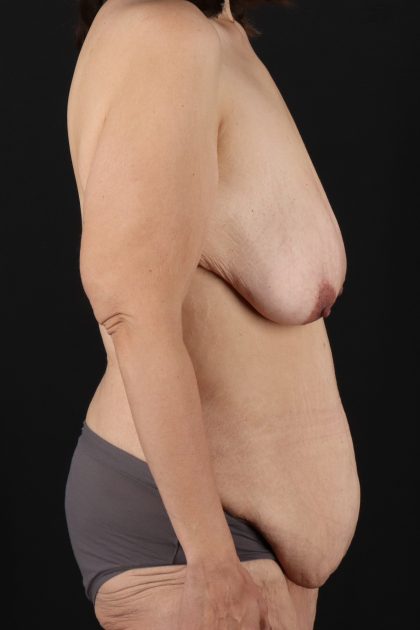 All Me Augmentation Before & After Patient #1908