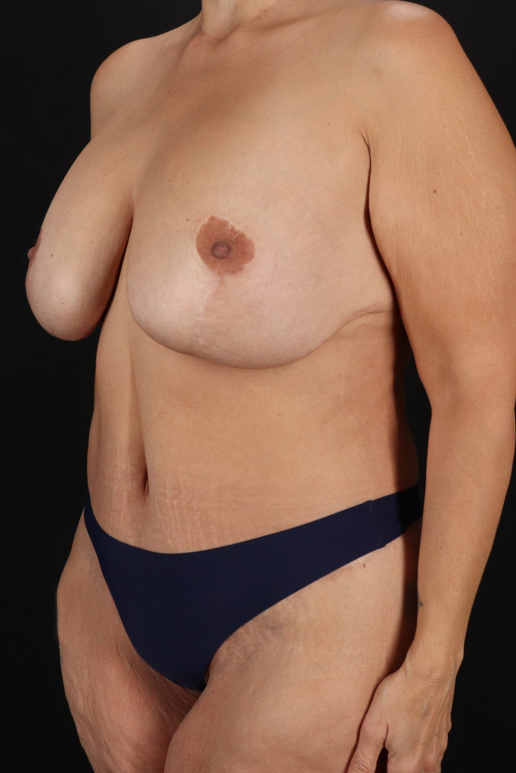 All Me Augmentation Before & After Patient #1908