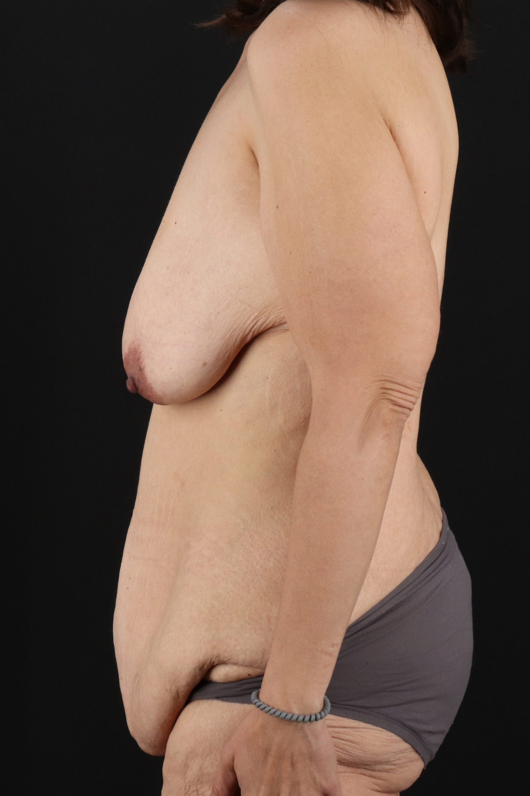 All Me Augmentation Before & After Patient #1908