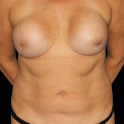 All Me Augmentation Before & After Patient #1909