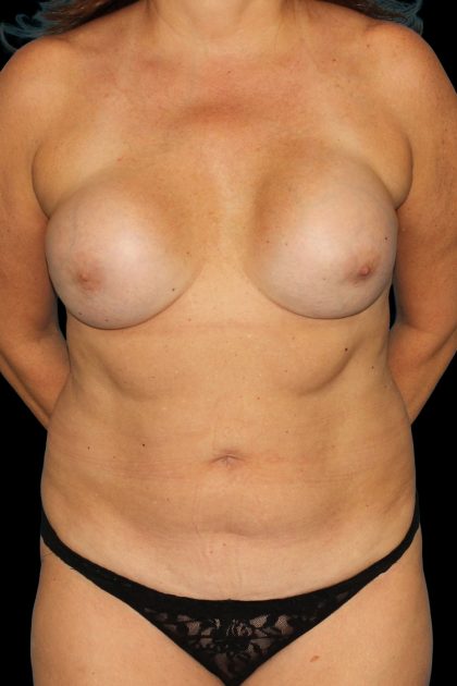 All Me Augmentation Before & After Patient #1909