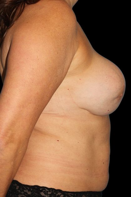 All Me Augmentation Before & After Patient #1909