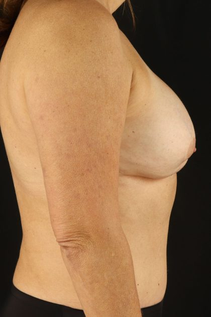 All Me Augmentation Before & After Patient #1909