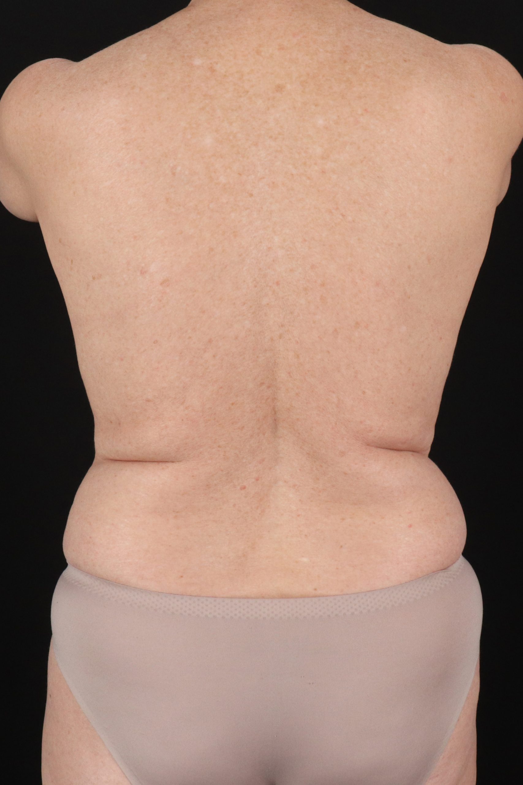 All Me Augmentation Before & After Patient #1910