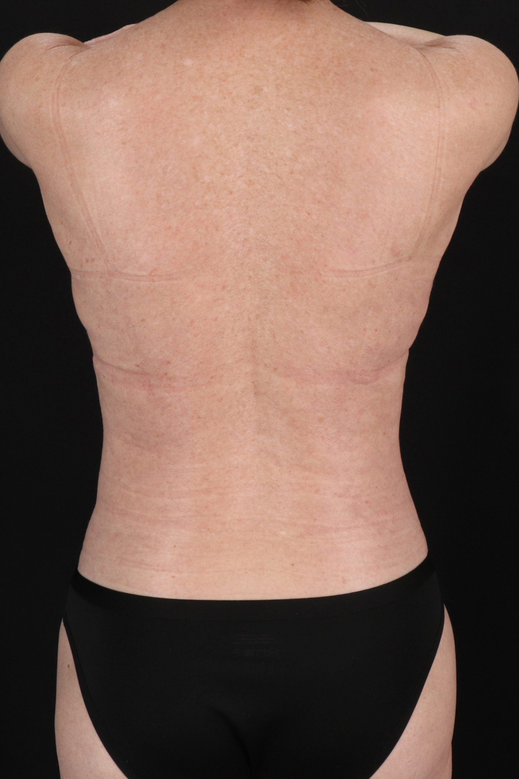 All Me Augmentation Before & After Patient #1910