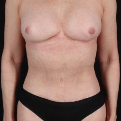 All Me Augmentation Before & After Patient #1910